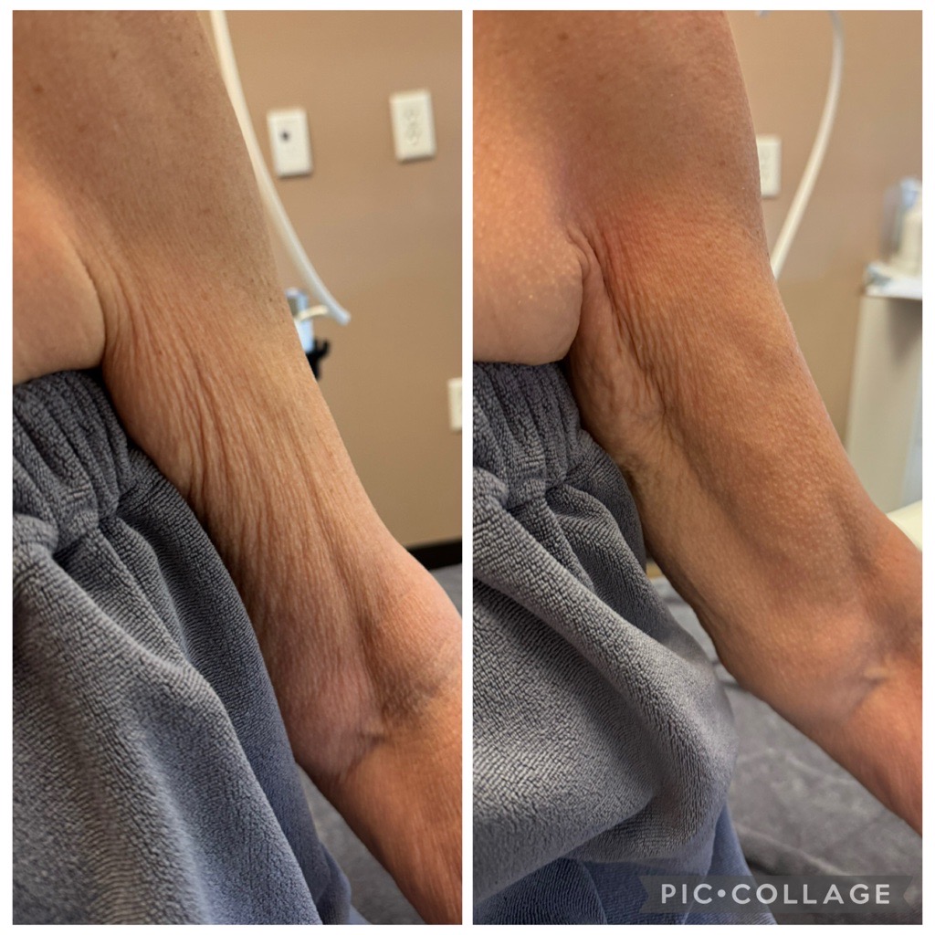 XERF body contouring result 3