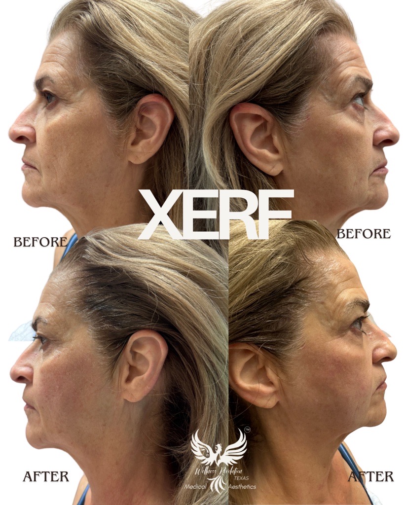XERF body contouring result 4